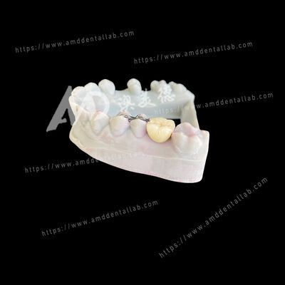 Buen precio PFM Maryland Bridge Un Póntico Dos Alas Una Solución Conservadora y Estética en línea